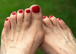 Truth About Bunions