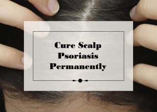 How to Cure Scalp Psoriasis Permanently